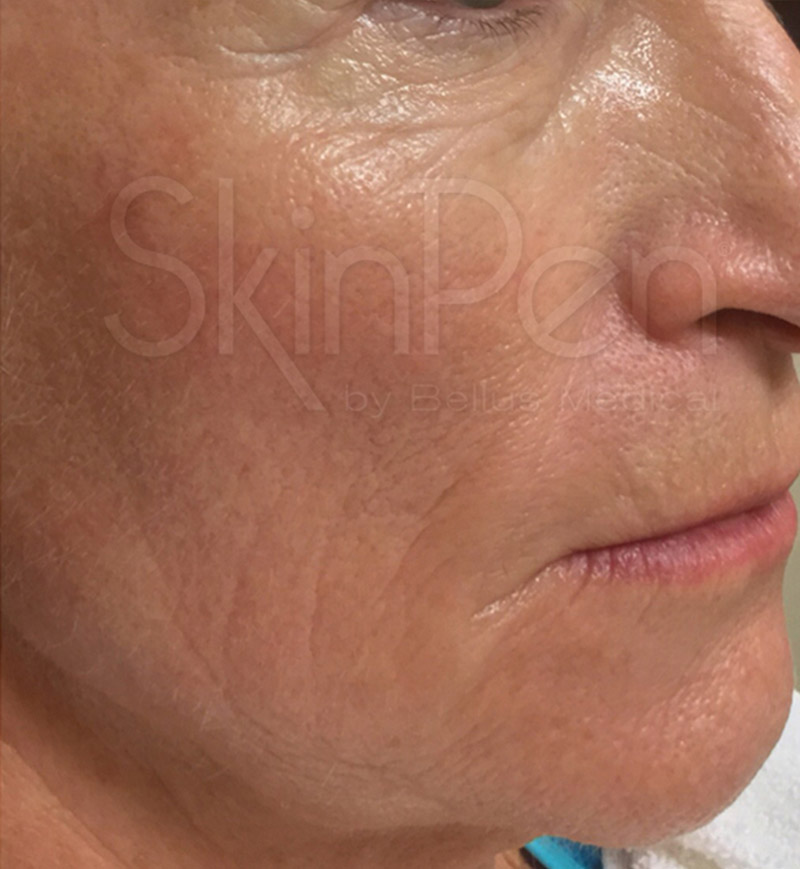 Microneedling After 1
