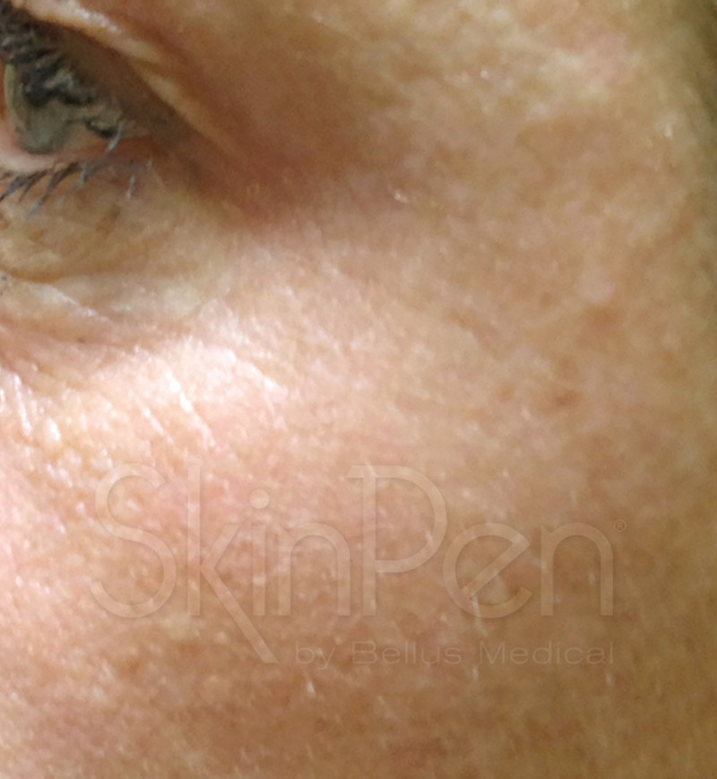 Microneedling After 2