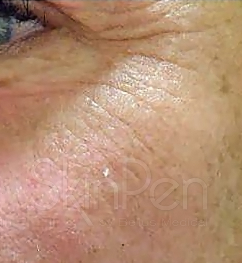 Microneedling Before 2